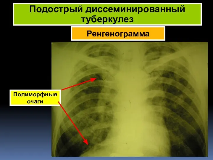 Ренгенограмма Подострый диссеминированный туберкулез Полиморфные очаги