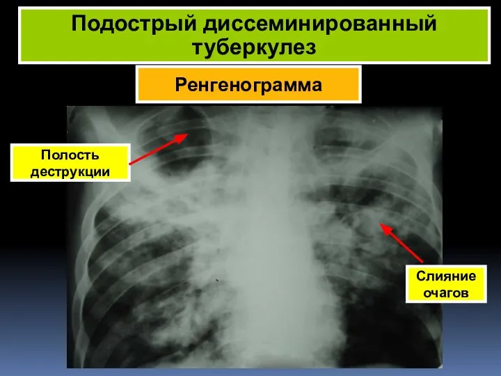 Ренгенограмма Подострый диссеминированный туберкулез Полость деструкции Слияние очагов