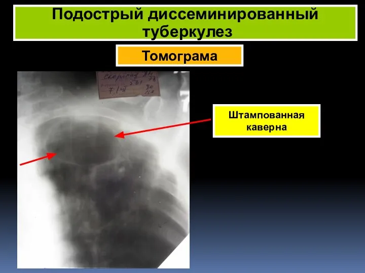 Томограма Подострый диссеминированный туберкулез Штампованная каверна