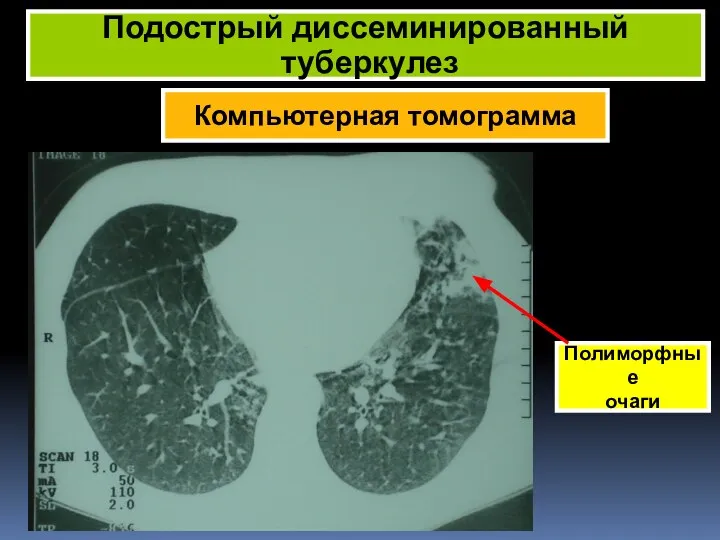 Компьютерная томограмма Подострый диссеминированный туберкулез Полиморфные очаги