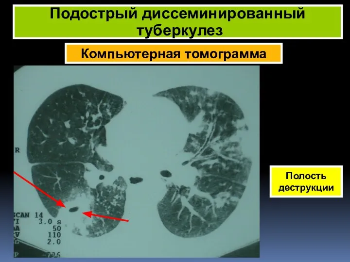 Компьютерная томограмма Подострый диссеминированный туберкулез Полость деструкции