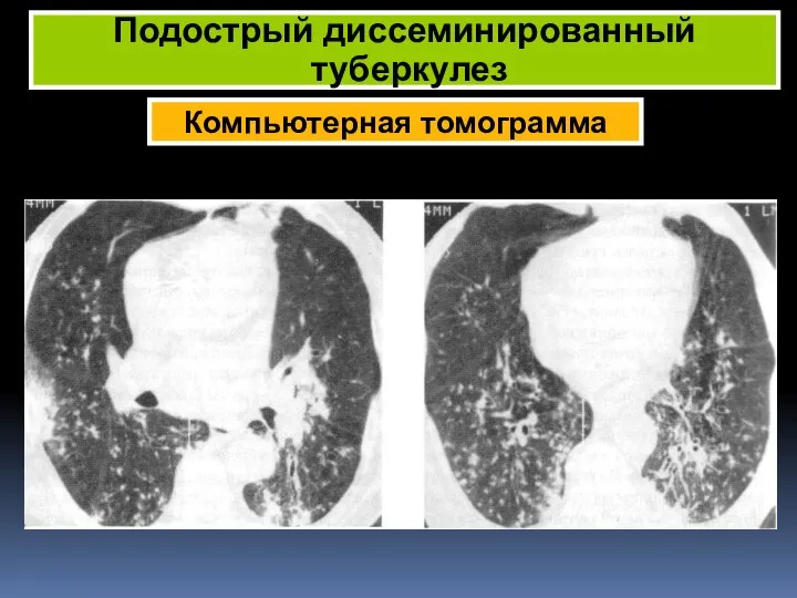 Компьютерная томограмма Подострый диссеминированный туберкулез