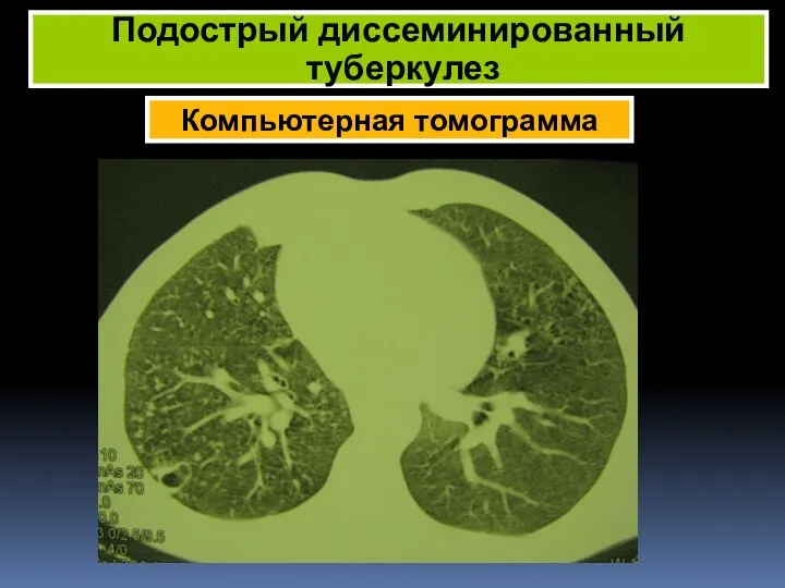 Компьютерная томограмма Подострый диссеминированный туберкулез