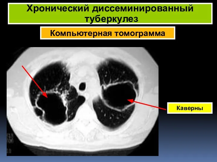 Компьютерная томограмма Хронический диссеминированный туберкулез Каверны