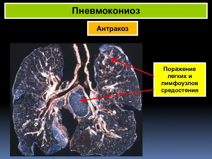 Антракоз Пневмокониоз Поражение легких и лимфоузлов средостения