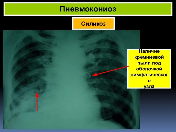 Силикоз Пневмокониоз Наличие кремниевой пыли под оболочкой лимфатического узла