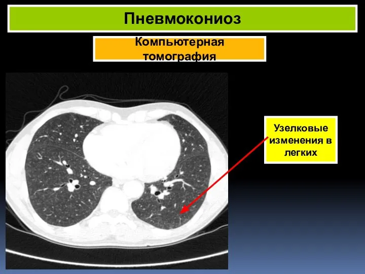 Компьютерная томография Пневмокониоз Узелковые изменения в легких