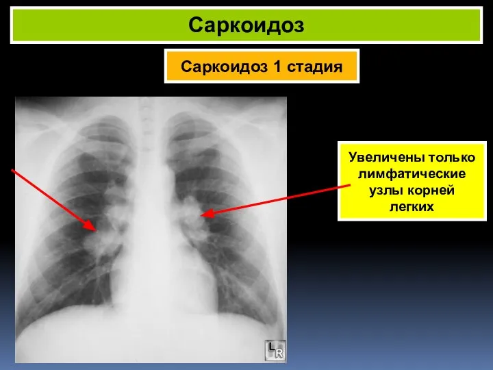 Саркоидоз 1 стадия Саркоидоз Увеличены только лимфатические узлы корней легких