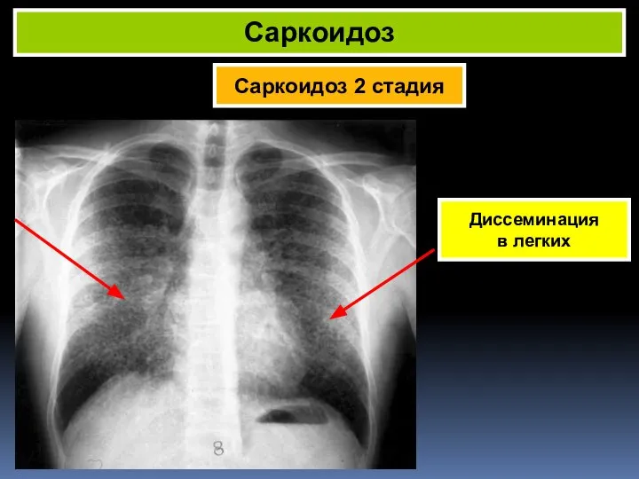 Саркоидоз 2 стадия Саркоидоз Диссеминация в легких