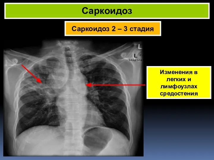 Саркоидоз 2 – 3 стадия Саркоидоз Изменения в легких и лимфоузлах средостения