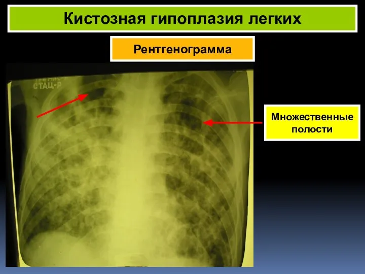 Рентгенограмма Кистозная гипоплазия легких Множественные полости