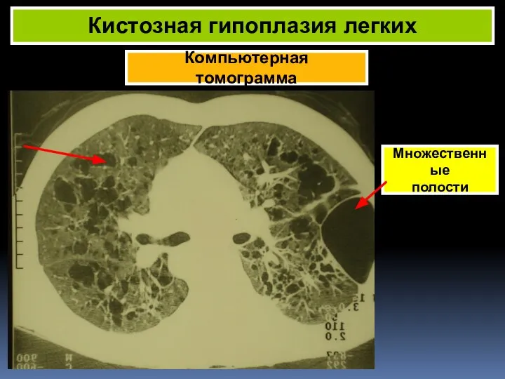 Компьютерная томограмма Кистозная гипоплазия легких Множественные полости