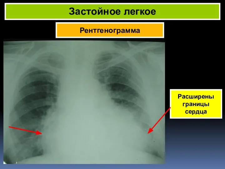 Рентгенограмма Застойное легкое Расширены границы сердца