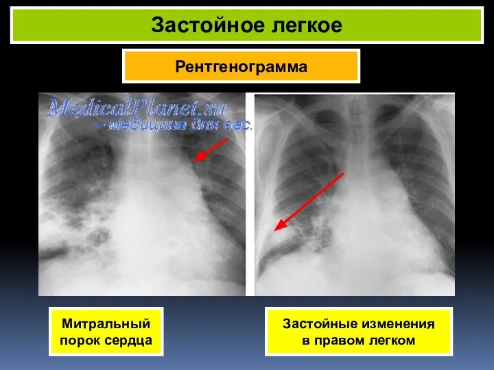 Рентгенограмма Застойное легкое Митральный порок сердца Застойные изменения в правом легком