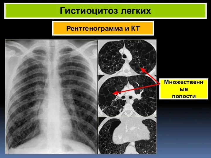 Рентгенограмма и КТ Гистиоцитоз легких Множественные полости