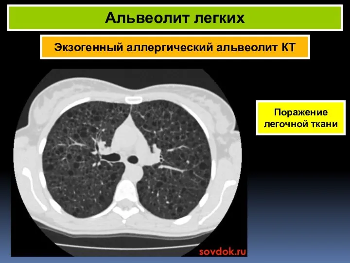 Экзогенный аллергический альвеолит КТ Альвеолит легких Поражение легочной ткани