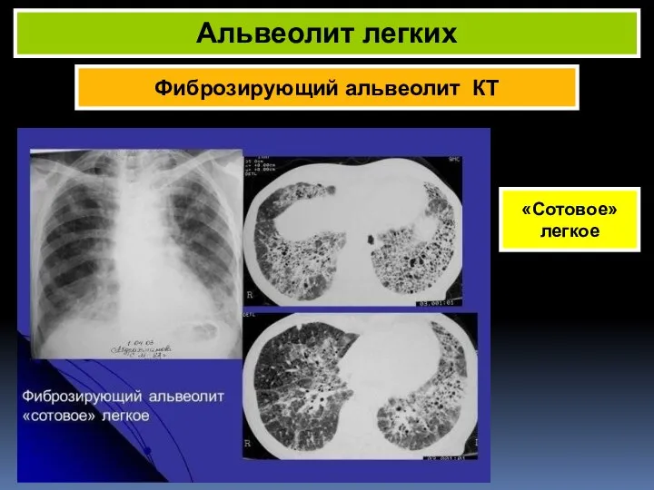 Фиброзирующий альвеолит КТ Альвеолит легких «Сотовое» легкое