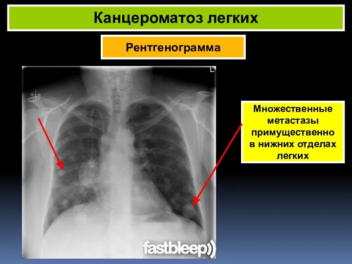 Рентгенограмма Канцероматоз легких Множественные метастазы примущественно в нижних отделах легких