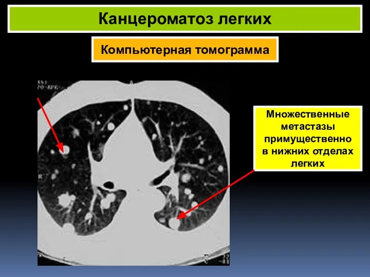 Компьютерная томограмма Канцероматоз легких Множественные метастазы примущественно в нижних отделах легких