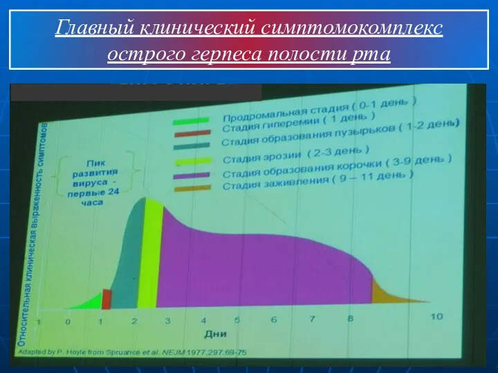 Главный клинический симптомокомплекс острого герпеса полости рта