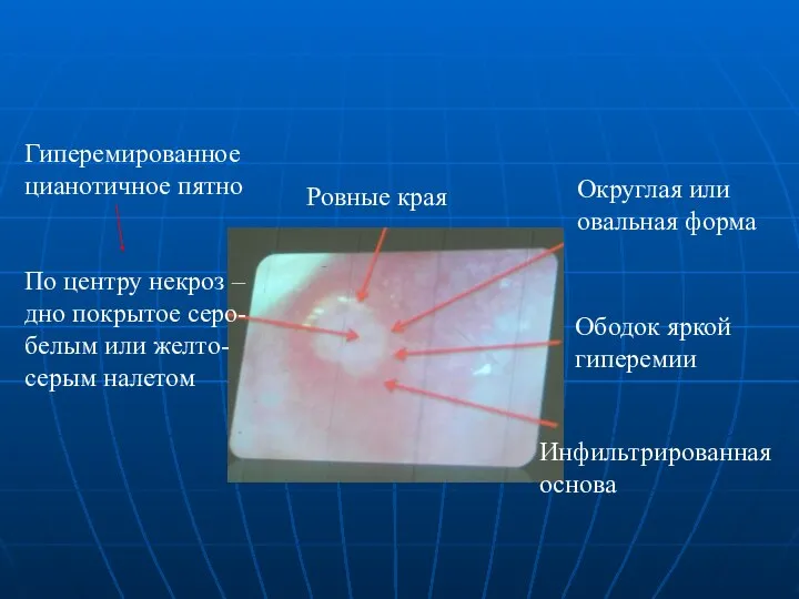 Гиперемированное цианотичное пятно По центру некроз – дно покрытое серо-белым или