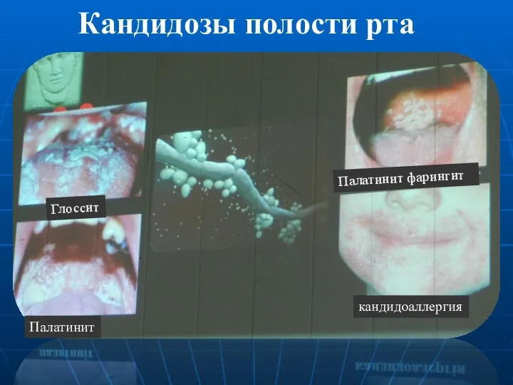 Глоссит Палатинит Палатинит фарингит кандидоаллергия Кандидозы полости рта