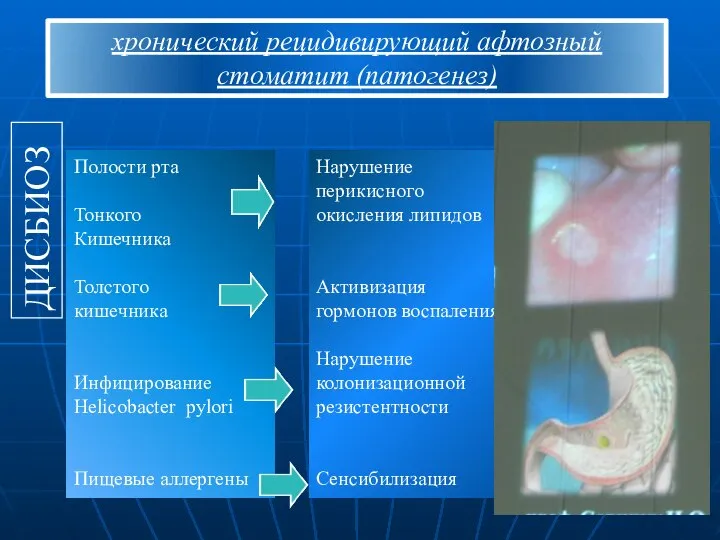 хронический рецидивирующий афтозный стоматит (патогенез) ДИСБИОЗ Полости рта Тонкого Кишечника Толстого