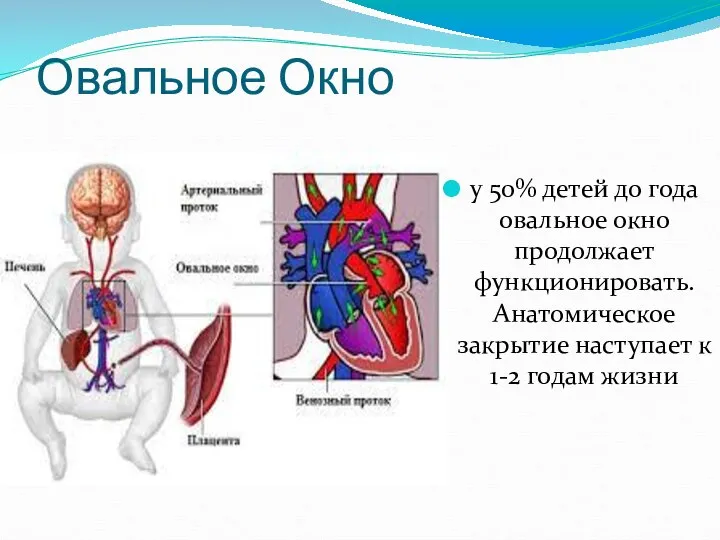 Овальное Окно у 50% детей до года овальное окно продолжает функционировать.