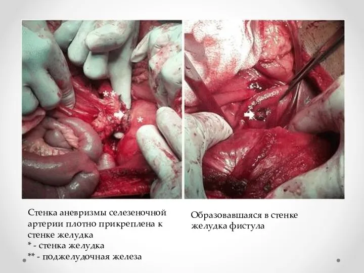 Стенка аневризмы селезеночной артерии плотно прикреплена к стенке желудка * -