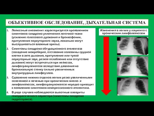 ОБЪЕКТИВНОЕ ОБСЛЕДОВАНИЕ, ДЫХАТЕЛЬНАЯ СИСТЕМА Лейкозный пневмонит характеризуется проявлением симптомов синдрома уплотнения