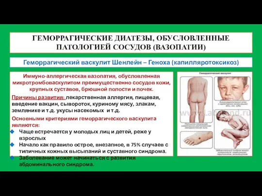 ГЕМОРРАГИЧЕСКИЕ ДИАТЕЗЫ, ОБУСЛОВЛЕННЫЕ ПАТОЛОГИЕЙ СОСУДОВ (ВАЗОПАТИИ) Геморрагический васкулит Шенлейн – Геноха