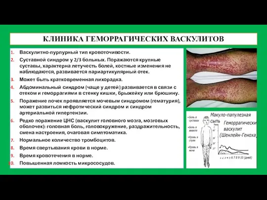 КЛИНИКА ГЕМОРРАГИЧЕСКИХ ВАСКУЛИТОВ Васкулитно-пурпурный тип кровоточивости. Суставной синдром у 2/3 больных.