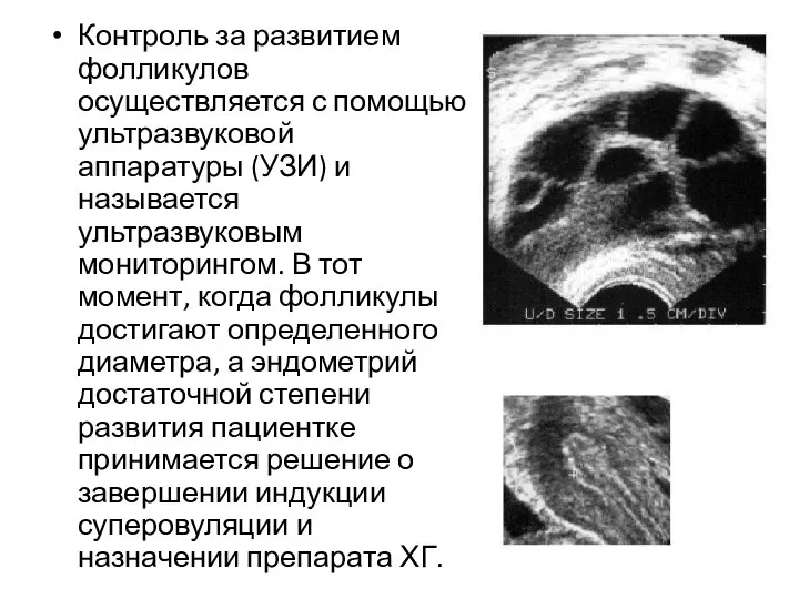 Контроль за развитием фолликулов осуществляется с помощью ультразвуковой аппаратуры (УЗИ) и