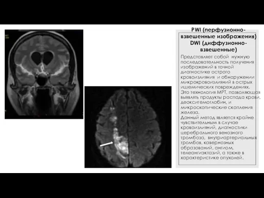 PWI (перфузионно- взвешенные изображения) DWI (диффузионно-взвешенные) Представляет собой нужную последовательность получения