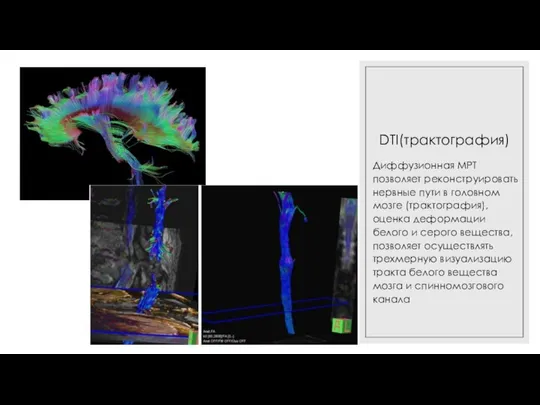 DTI(трактография) Диффузионная МРТ позволяет реконструировать нервные пути в головном мозге (трактография),