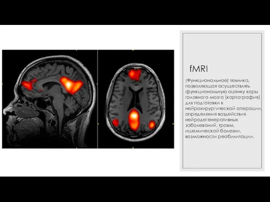 fMRI (Функциональное) техника, позволяющая осуществлять функциональную оценку коры головного мозга (картография)