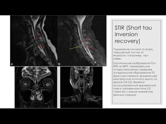 STIR (Short tau inversion recovery) Подавление сигнала от жира, повышенный сигнал