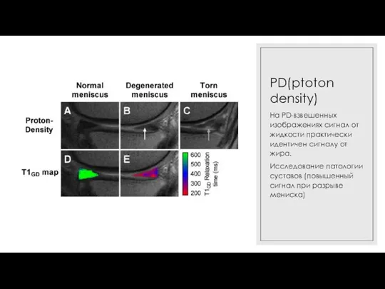 PD(ptoton density) На PD-взвешенных изображениях сигнал от жидкости практически идентичен сигналу