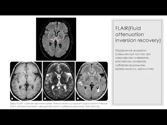 FLAIR(Fluid attenuation inversion recovery) Подавление жидкости (повышенный сигнал при лакунарном инфаркте, рассеяном склерозе, субарахноидальном кровоизлиянии, менингите)