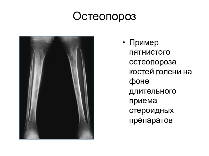 Остеопороз Пример пятнистого остеопороза костей голени на фоне длительного приема стероидных препаратов