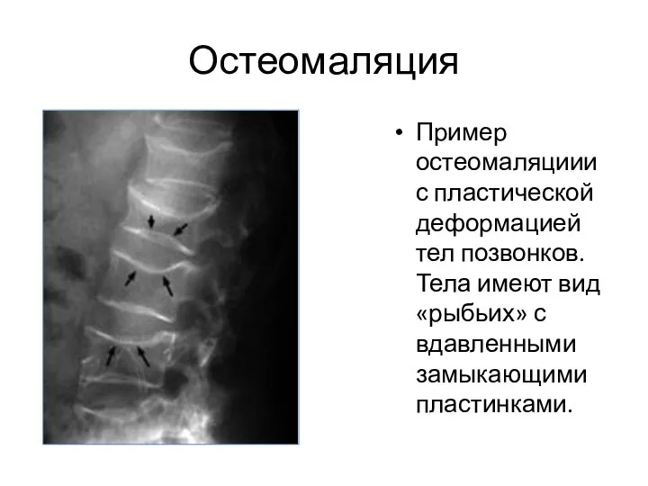 Остеомаляция Пример остеомаляциии с пластической деформацией тел позвонков. Тела имеют вид «рыбьих» с вдавленными замыкающими пластинками.