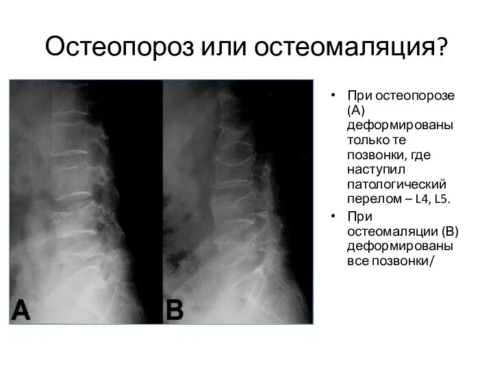 Остеопороз или остеомаляция? При остеопорозе (А) деформированы только те позвонки, где