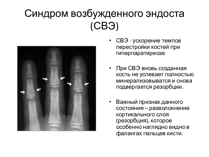 Синдром возбужденного эндоста (СВЭ) СВЭ - ускорение темпов перестройки костей при