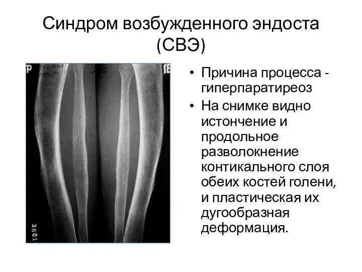 Синдром возбужденного эндоста (СВЭ) Причина процесса - гиперпаратиреоз На снимке видно