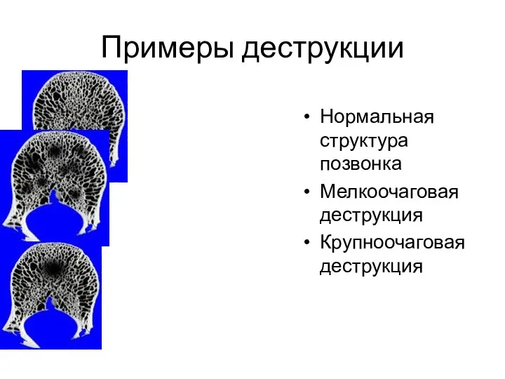 Примеры деструкции Нормальная структура позвонка Мелкоочаговая деструкция Крупноочаговая деструкция