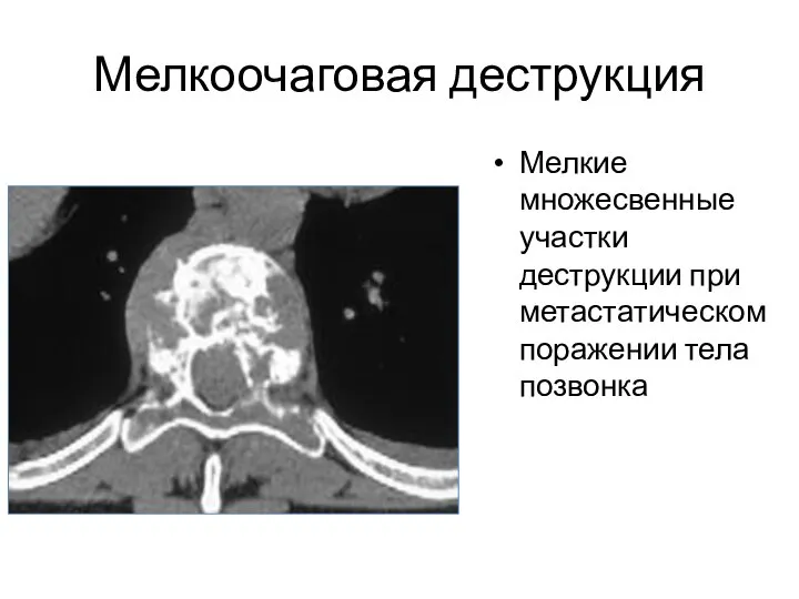 Мелкоочаговая деструкция Мелкие множесвенные участки деструкции при метастатическом поражении тела позвонка