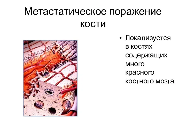 Метастатическое поражение кости Локализуется в костях содержащих много красного костного мозга