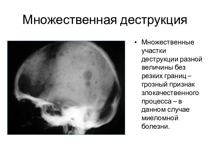 Множественная деструкция Множественные участки деструкции разной величины без резких границ –