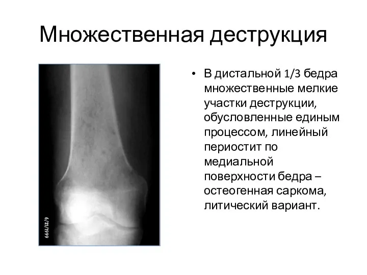 Множественная деструкция В дистальной 1/3 бедра множественные мелкие участки деструкции, обусловленные