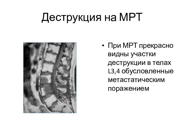 Деструкция на МРТ При МРТ прекрасно видны участки деструкции в телах L3,4 обусловленные метастатическим поражением